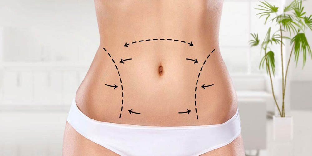 Lipoaspiração ou abdominoplastia qual é a mais indicada para o meu caso Dr Veimar Roberto