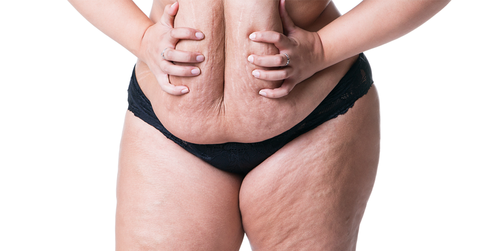 Quanto tempo depois da cirurgia bariátrica posso fazer abdominoplastia?