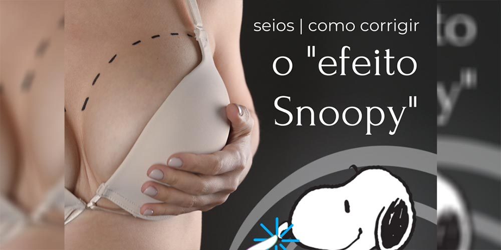 Seios | Como corrigir o “efeito snoopy”?